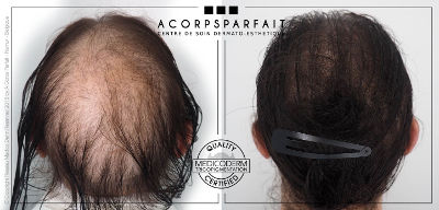 Tricopigmentation sur femme