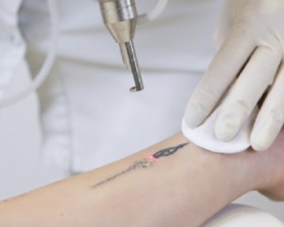 Laser Tattoo Removal